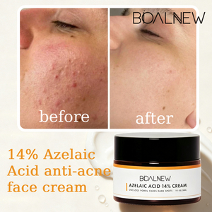 Crème Visage OEM 14% Acide Azélaïque Anti-acné, Éclaircissante, Traitement des Cicatrices Cutanées, Rafraîchissante, Estompe les Cicatrices et les Taches Brunes - Product Image 2
