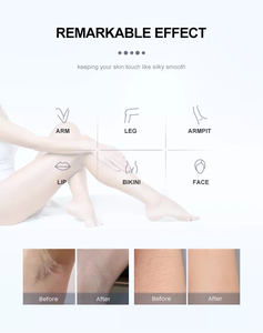 Máquina de Depilación Láser de Diodo de 3 Longitudes de Onda (755, 808, 1064) con Enfriamiento por Hielo, 2000W, para Todo Tipo de Piel - Product Image 6