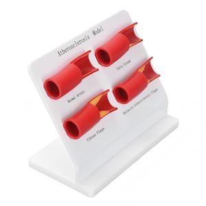 Modelo de Aterosclerosis, Juego de Modelos de Arterias, Progresión de Enfermedades Vasculares en 4 Etapas, Modelo Anatómico para Enseñanza Médica - Product Image 4