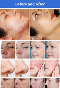 clinical use New 1927nm Thulium <b>Machine</b> for Acne Scars skin whitening anti aging device - Product Image 6