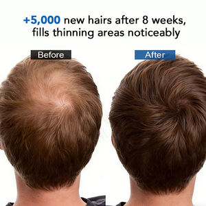 Ampoules de croissance capillaire <span class=keywords><strong>pour</strong></span> hommes NUSPA Upgrade, infusées au ginseng et aux feuilles de thuya, augmentent de 5000 poils après 8 semaines - Product Image 6