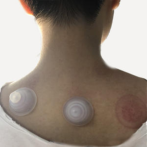 Вакуумные банки для массажа, с магнитными шариками - Product Image 4