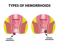 Bonne qualité 980nm meilleurs traitements des hémorroïdes fistule fissure Pilonidal Sinus dispositif