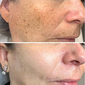 Kojic Papaya เซรั่มสำหรับผิวหน้า,น้ำมันสำหรับจุดด่างดำจุดด่างดำจุดด่างดำจุดด่างดำจุดด่างดำรอยสิวจุดด่างดำ - Product Image 2
