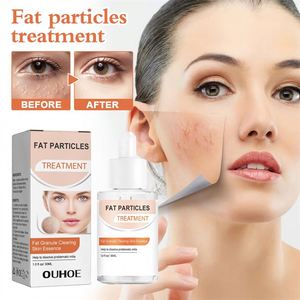 OUHOE - Esencia Facial de 30 ml para Eliminar Grasa y Granos, Tratamiento para Erupciones Cutáneas, Papules y Pústulas, Suero Facial - Product Image 2