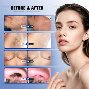 2025 Hot Bán 1 tay cầm ice bạch kim Diode tẩy lông bằng laser giá máy Professionnel 4 bước sóng Tec làm mát Diode Laser - Product Image 6