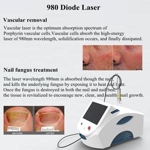 Mesin Laser Diode 980nm Portabel Berkualitas Tinggi untuk Penghapusan Jamur Kuku dan Terapi Lesi Vaskular - Product Image 1