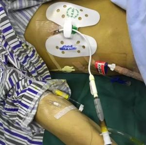 อุปกรณ์ช่วยลดการสั่นไหวของท่อน้ำดีแบบใช้แล้วทิ้งที่เก็บสายสวนส่วนกลางอุปกรณ์รักษาเสถียรภาพของทางเดินน้ำดี - Product Image 6