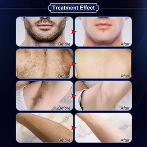 เครื่องเลเซอร์ไดโอดน้ำแข็งสำหรับกำจัดขน808nm ไม่เจ็บปวด - Product Image 5