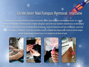 Système de diodes professionnel 980 nm pour le traitement des mycoses des ongles des pieds et des mains - Product Image 3