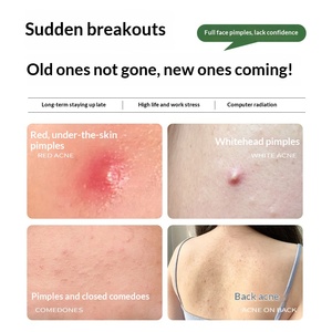 สปอตทรีทเมนท์ แอคเน่ สำหรับลดรอยสิว รอยแดง <span class=keywords><strong>สิว</strong></span>อักเสบ <span class=keywords><strong>สิว</strong></span>หัวปิด TK วอเตอร์ พาวเดอร์ - Product Image 3