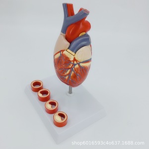 Stent cardiaque, bypass des artères coronaires, chirurgie ouverte de la valve cardiaque, thrombose humaine, démonstration de la structure cardiaque et vasculaire - Product Image 5