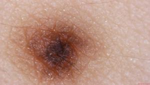 Dermatoscopio Polarizzatore per Dermatologi con Ugelli Sostituibili per iPhone iPad Android - Product Image 3