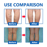 Crème de traitement des varices OEM, efficace pour soulager les jambes, formule de pommade pour les varices, dilatation vasculaire, phlébite