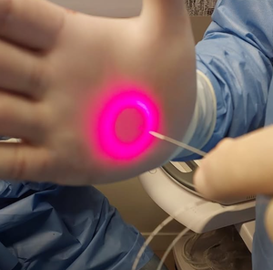 Fibra Óptica Radial SMA905 Endolaser (200um, 400um, 600um, 800um) para Lipólisis, Tratamiento de Venas Varicosas y Hemorroides - Product Image 1