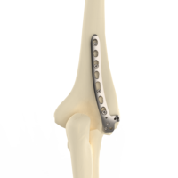 Plaque de fixation humérale CANWELL 02 en titane, distale latérale dorsale, anatomique, pour chirurgie orthopédique traumatique et fractures, certifiée CE, OEM, Classe A