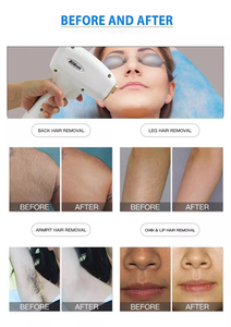 เครื่องกำจัดขนด้วยเลเซอร์ไดโอด 755 808 1064 นาโนเมตร สำหรับใช้ส่วนตัวบนโต๊ะทำงาน ระบบทำความเย็นด้วยน้ำแข็ง สำหรับใบหน้าและมือ ใช้ได้ทั่วโลก - Product Image 6