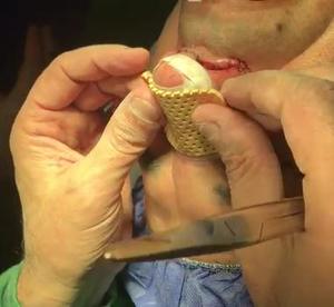 Férula Nasal Termoplástica Externa <span class=keywords><strong>Aquaplast</strong></span> para Rinoplastia, Cirugía Plástica, Inmovilización y Fijación del Puente Nasal - Product Image 1