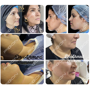 Perangkat Pengencang Wajah S1Pro Laser Medis Estetika Diode 1470nm untuk Peremajaan Kulit Endolifting ISO13485 - Product Image 3