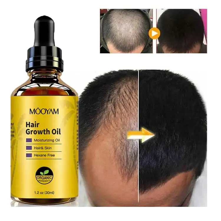 Óleo para crescimento capilar, óleo para crescimento e fortalecimento do cabelo de 30 dias para homens e mulheres