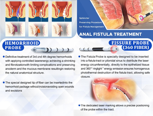 Mesin pembasmi ambeien, mesin pengobatan ambeien, pengobatan Laser Excision, ambeien, penghilang ambeien dan ambeien - Product Image 4