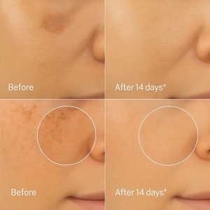 Crema Blanqueadora Antipekas y Antimanchas en 14 Días, Potente y Fuerte con Vitamina C y Ácido Kójico, Crema en Sérum para la Eliminación de Manchas Oscuras - Product Image 5