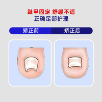 [Xin Zhangmen] Patchs de fixation et de soin des ongles 10 patchs/boîte, Correcteur de rainure d'ongle, Patch orthognathique, Assistance physique