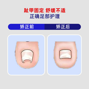 [Xin Zhangmen] Toenail Fixation and Care Patches 10 Patches/Box, Nail Groove Corrector, Orthognathic Patch, <b>Physical</b> Assistance - Product Image 3