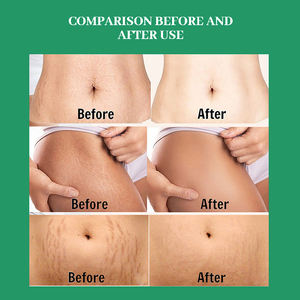 <span class=keywords><strong>COBEN</strong></span> - El Mejor Sérum para las Piernas Durante el Embarazo, Eficaz Contra las Estrías, Repara y Elimina Cicatrices, Aceite 100% Natural y Orgánico para Eliminar las Estrías - Product Image 6