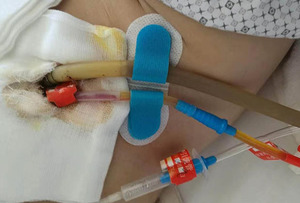 3cmx9cm Sterile <strong>Medical</strong> IV Site Catheter Stabilization Device <strong>Medical</strong> Wound <strong>Plaster</strong> IV Start Fixation Device