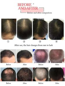 The Most Cost-effective 5 In1 High Frequency Wand Hair Growth <b>Head</b> <b>Massage</b> Hair Follicles Scalp Hair Analyzer Machine - Product Image 2