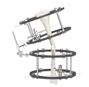CANWELL Wrist <strong>External</strong> <strong>Fixator</strong> Small Bones Fracture Fixation Mini <strong>External</strong> <strong>Fixator</strong> Orthopedic <strong>Implant</strong> Phalanges and Metacarpals - Product Image 4