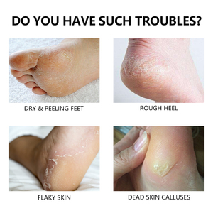 Gel Rimuovi Calli Extra Forte OEM di Grado Professionale per Talloni Secchi e Screpolati, Rimozione <span class=keywords><strong>Pelle</strong></span> Morta, Pedicure da Salone per Piedi a Casa - Product Image 4