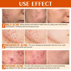 Effective And Fast Acne Removal Cream Rapid Acne Removal Eliminate Redness And Swelling 100g MOOYAM Acne Removal Cream