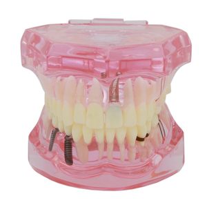 1 modèle dentaire d'étude et de démonstration d'implant dentaire avec restauration, rose - Product Image 3