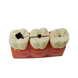 Modelo educativo de ciencia médica, modelo de desmontaje de caries de tamaño 4 veces - Product Image 1