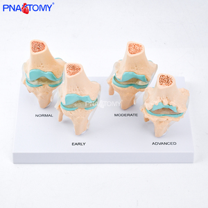 Modelo de Articulación de <span class=keywords><strong>Rodilla</strong></span> Humana de 4 Etapas con Osteoartritis Patológica, Herramienta Educativa para Profesores de Ciencias Anatómicas, Enseñanza Médica - Product Image 2