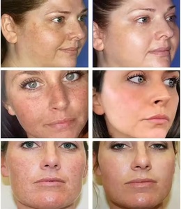 Crème de soins de la peau pour blanchir les taches de rousseur élimination de la pigmentation réparation rapide de la mélanine éclaircir la niacinamide livraison directe - Product Image 4