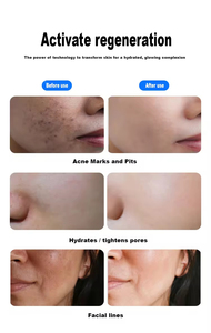 2026 New Arrival Multi-Needles Injection MesoGun Anti-aging Wrinkle Reduction Dermal Mesotherapy - Product Image 5