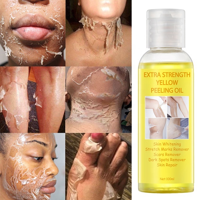Gelbes Peeling-Öl Für Dunkle Haut – Super Stark – Gegen Schwarze Flecken & Für Glatten Teint