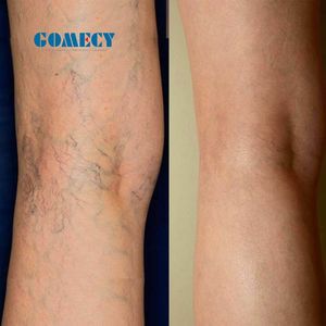 Peralatan Kecantikan Laser 15W 980Nm untuk Penghapusan Pembuluh Darah Merah dan Penghapusan Spider Veins di Wajah - Product Image 2