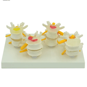 인간 척추 모델에서 정상 요추 및 4 단 요추 디스크 허리 병변 모델 - Product Image 6