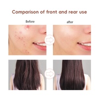 Appareil de beauté facial portable 4 en 1, traitement de l'acné par électrodes, thérapie à l'ozone, baguette de beauté faciale haute fréquence