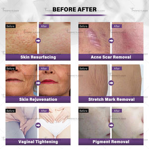 Medische Kwaliteit Vaginale Aanscherping Gynaecologie Esthetische Vulva Verjonging Co2 Fractionele Laser - Product Image 4