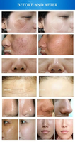 Équipement de beauté lifting du visage machine de dermabrasion médicale machine à peler à jet pour salon spa