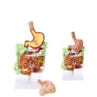 Modelo patológico de intestino grueso, lesiones gastrointestinales, modelo anatómico, enfermedad intestinal, modelo de lesiones de colon humano