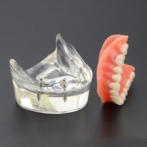 Modello di denti dentali di restauro di Overdenture di vendita calda/modello di studio dentale - Product Image 1