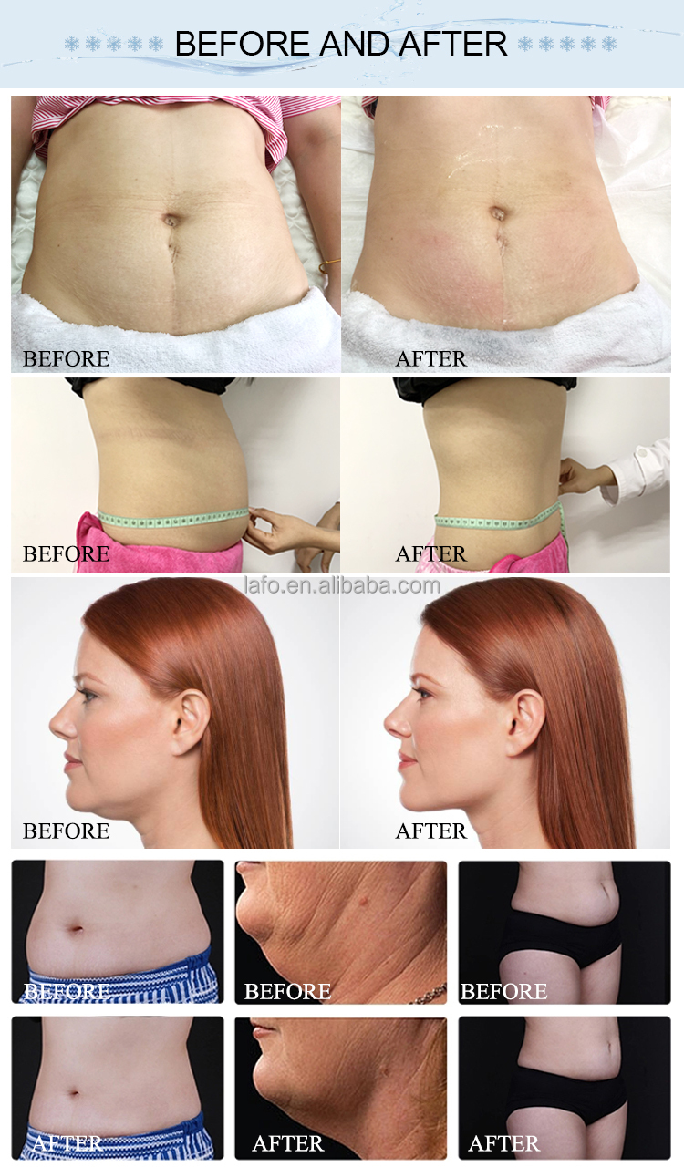 Professional stationary 360 Cool system Cryolipolysis Weight Loss Cryo Double Chin Removal Machine LF-245B