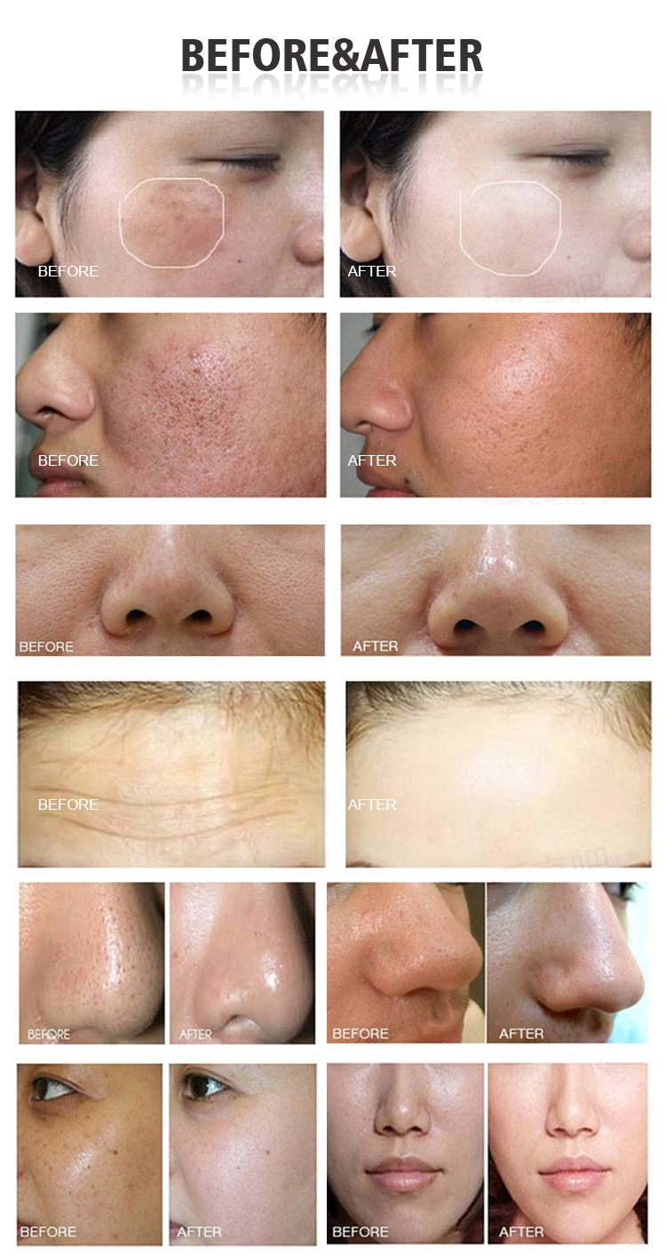 Multifunction Diamond Microdermabrasion Facial Peel Water Hydro Dermabrasion Machine