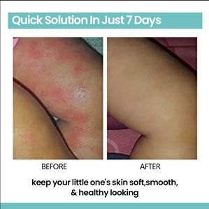 Meizheng ครีมต้านเชื้อรา15g สูตรสมุนไพร bacteriostat สำหรับร่างกายบรรเทาอาการทางคลินิกโรคเท้าผิวหนังอักเสบกลากแมลงกัด - Product Image 5